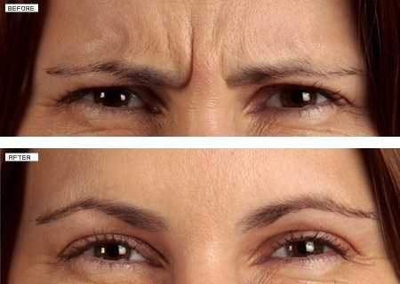 Glabella Botox