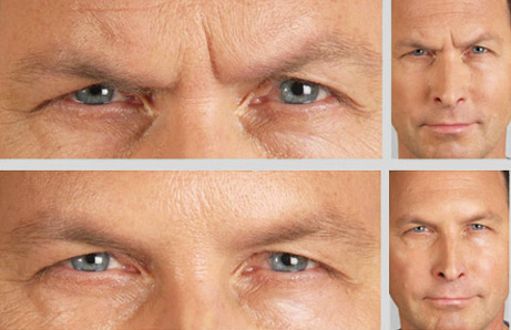 Men Forehead Wrinkles